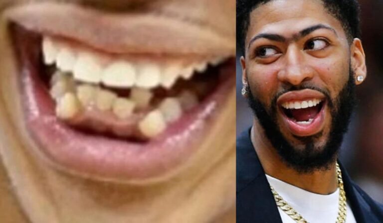 anthony davis teeth